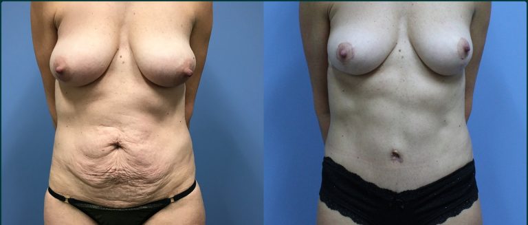 Breast lift (mastopexy) before and after, front view, female patient, case BLI-L10, Dr Rohit Kumar, Sydney