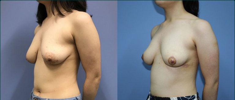 Breast lift (mastopexy) before and after, 45° left view, female patient, case BLI-L11, Dr Rohit Kumar, Sydney