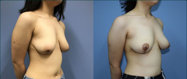 Breast lift (mastopexy) before and after, 45° right view, female patient, case BLI-L11, Dr Rohit Kumar, Sydney