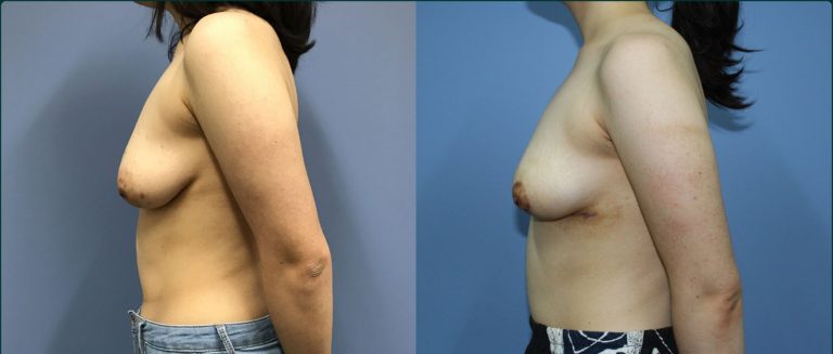Breast lift (mastopexy) before and after, 90° left view, female patient, case BLI-L11, Dr Rohit Kumar, Sydney