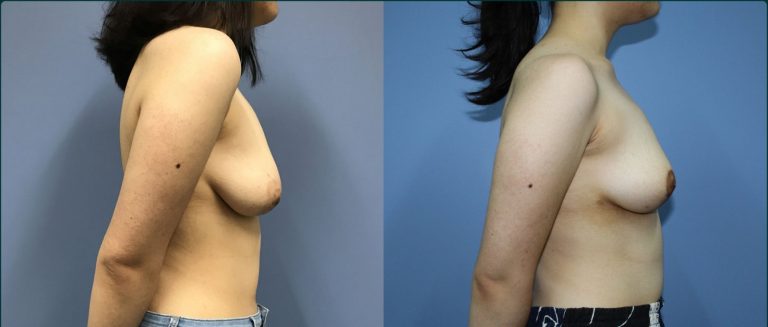 Breast lift (mastopexy) before and after, 90° right view, female patient, case BLI-L11, Dr Rohit Kumar, Sydney