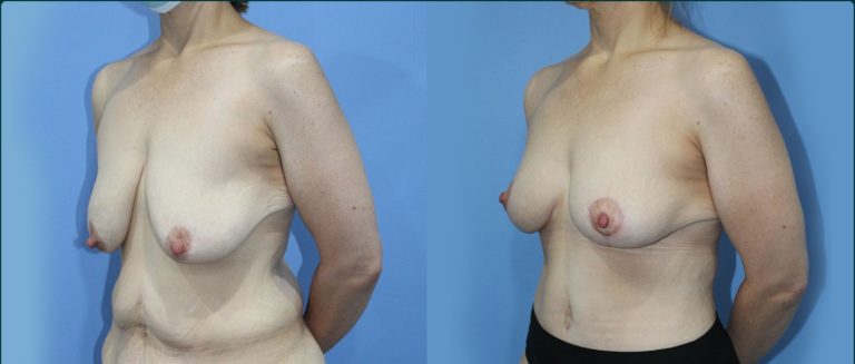 Breast lift (mastopexy) before and after, 45° left view, female patient, case BLI-L12, Dr Rohit Kumar, Sydney