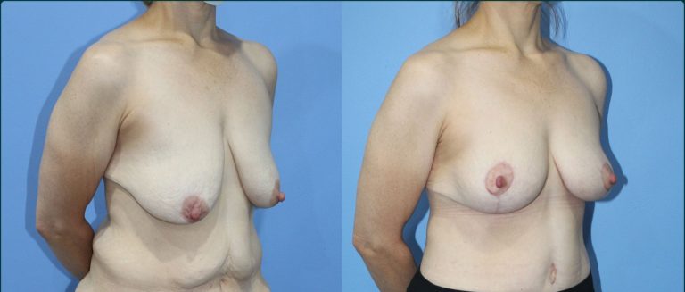 Breast lift (mastopexy) before and after, 45° right view, female patient, case BLI-L12, Dr Rohit Kumar, Sydney