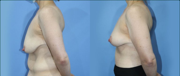 Breast lift (mastopexy) before and after, 90° left view, female patient, case BLI-L12, Dr Rohit Kumar, Sydney