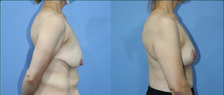 Breast lift (mastopexy) before and after, 90° right view, female patient, case BLI-L12, Dr Rohit Kumar, Sydney