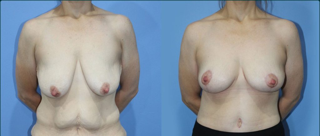 Breast lift (mastopexy) before and after, front view, female patient, case BLI-L12, Dr Rohit Kumar, Sydney