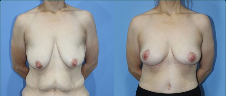 Breast lift (mastopexy) before and after, front view, female patient, case BLI-L12, Dr Rohit Kumar, Sydney