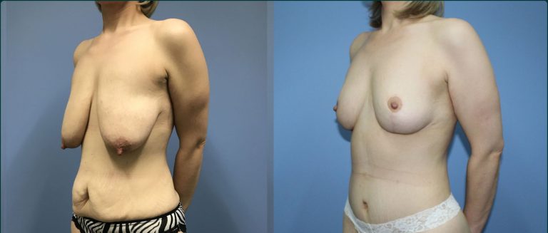 Breast lift (mastopexy) before and after, 45° left view, female patient, case BLI-L13, Dr Rohit Kumar, Sydney
