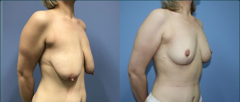Breast lift (mastopexy) before and after, 45° right view, female patient, case BLI-L13, Dr Rohit Kumar, Sydney