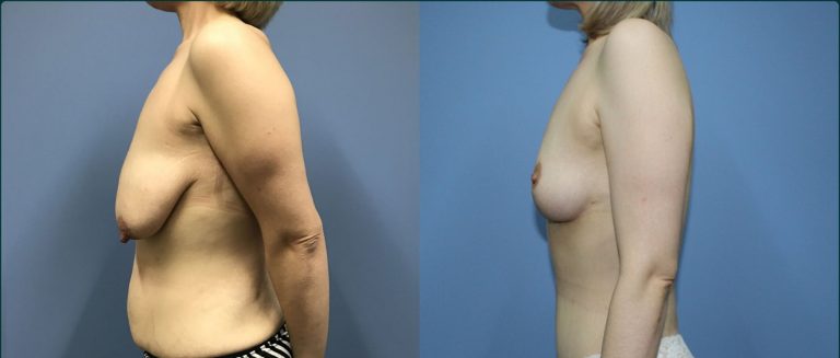 Breast lift (mastopexy) before and after, 90° left view, female patient, case BLI-L13, Dr Rohit Kumar, Sydney