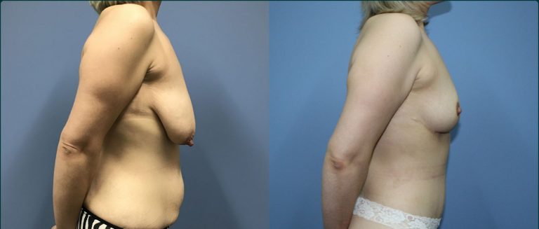 Breast lift (mastopexy) before and after, 90° right view, female patient, case BLI-L13, Dr Rohit Kumar, Sydney