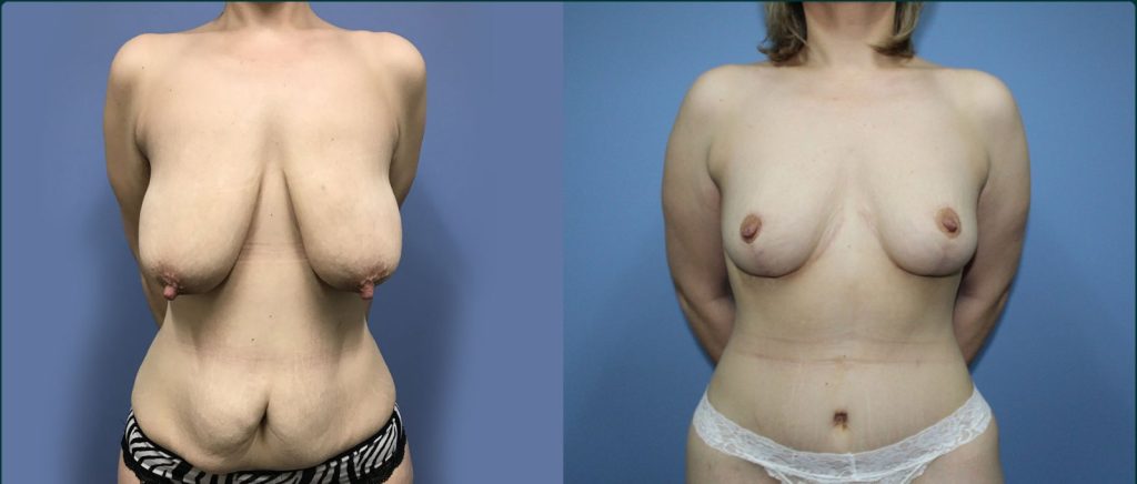 Breast lift (mastopexy) before and after, front view, female patient, case BLI-L13, Dr Rohit Kumar, Sydney