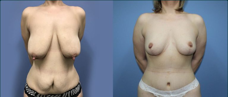 Breast lift (mastopexy) before and after, front view, female patient, case BLI-L13, Dr Rohit Kumar, Sydney