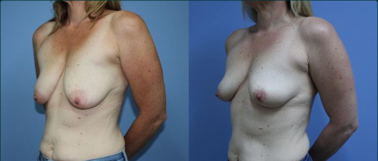 Breast lift (mastopexy) before and after, 45° left view, female patient, case BLI-L14, Dr Rohit Kumar, Sydney