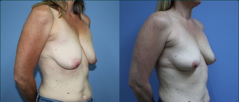Breast lift (mastopexy) before and after, 45° right view, female patient, case BLI-L14, Dr Rohit Kumar, Sydney
