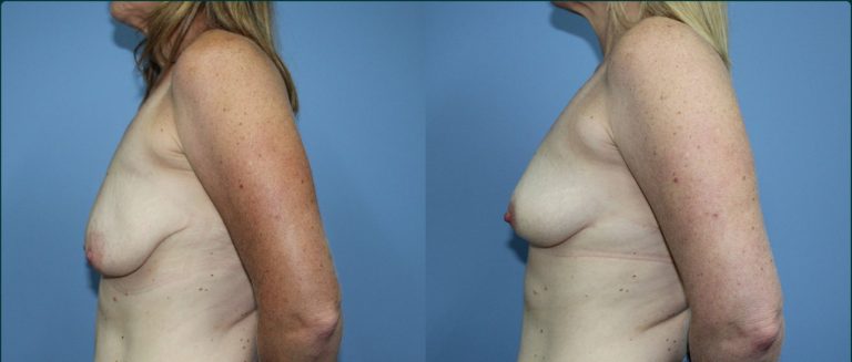 Breast lift (mastopexy) before and after, 90° left view, female patient, case BLI-L14, Dr Rohit Kumar, Sydney