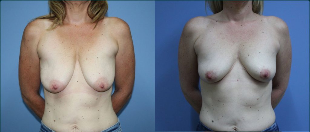 Breast lift (mastopexy) before and after, front view, female patient, case BLI-L14, Dr Rohit Kumar, Sydney