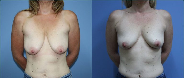 Breast lift (mastopexy) before and after, front view, female patient, case BLI-L14, Dr Rohit Kumar, Sydney