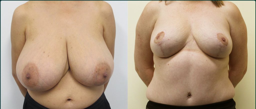 Breast reduction before and after, female patient, case BRR-L01, Dr Rohit Kumar, Sydney