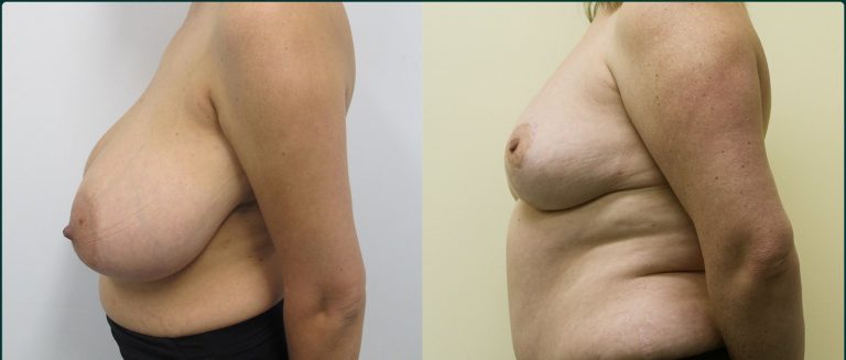 Breast reduction before and after, female patient, case BRR-L01, Dr Rohit Kumar, Sydney