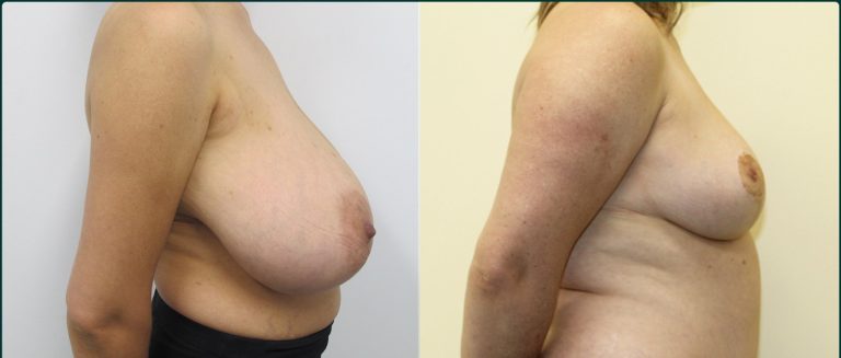 Breast reduction before and after, female patient, case BRR-L01, Dr Rohit Kumar, Sydney