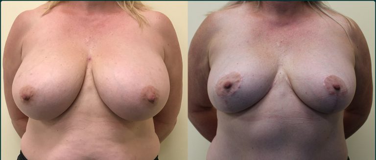 Breast reduction before and after, female patient, case BRR-L02, Dr Rohit Kumar, Sydney