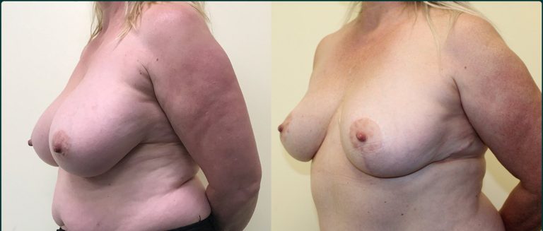 Breast reduction before and after, female patient, case BRR-L02, Dr Rohit Kumar, Sydney