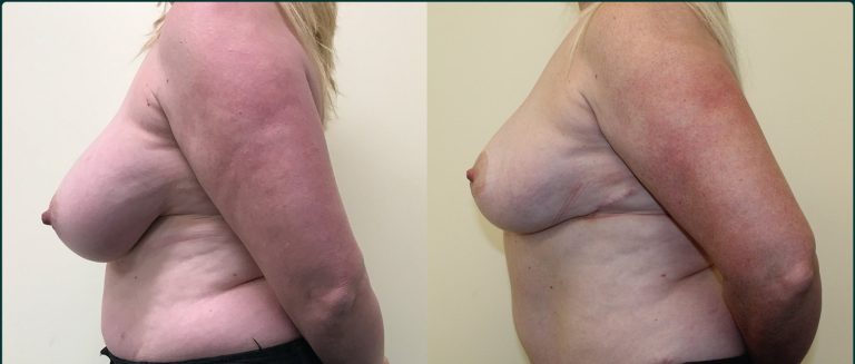 Breast reduction before and after, female patient, case BRR-L02, Dr Rohit Kumar, Sydney