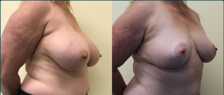 Breast reduction before and after, female patient, case BRR-L02, Dr Rohit Kumar, Sydney
