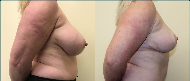 Breast reduction before and after, female patient, case BRR-L02, Dr Rohit Kumar, Sydney