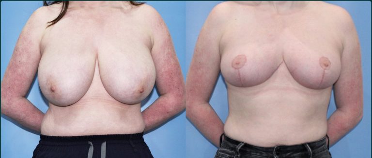 Breast reduction before and after, female patient, case BRR-L03, Dr Rohit Kumar, Sydney