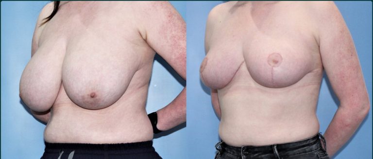 Breast reduction before and after, female patient, case BRR-L03, Dr Rohit Kumar, Sydney