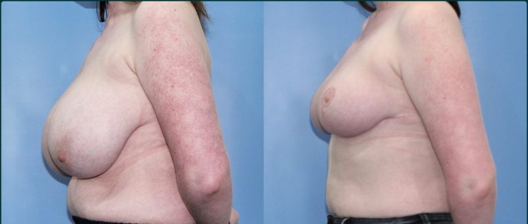 Breast reduction before and after, female patient, case BRR-L03, Dr Rohit Kumar, Sydney