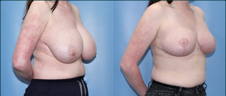 Breast reduction before and after, female patient, case BRR-L03, Dr Rohit Kumar, Sydney