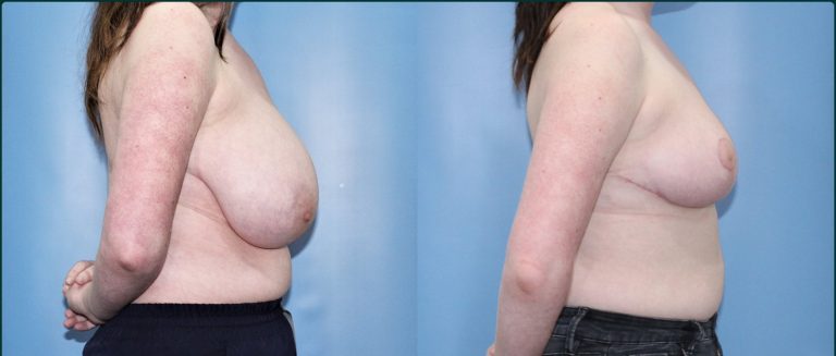 Breast reduction before and after, female patient, case BRR-L03, Dr Rohit Kumar, Sydney