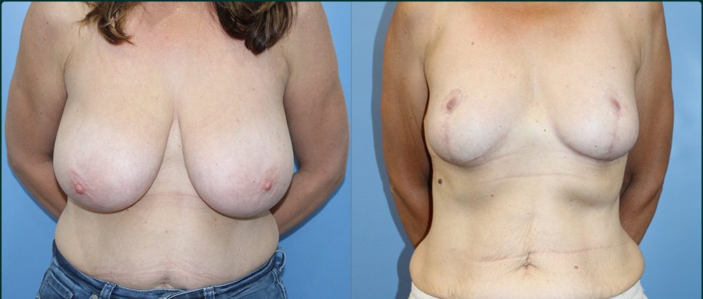 Breast reduction before and after, female patient, case BRR-L04, Dr Rohit Kumar, Sydney