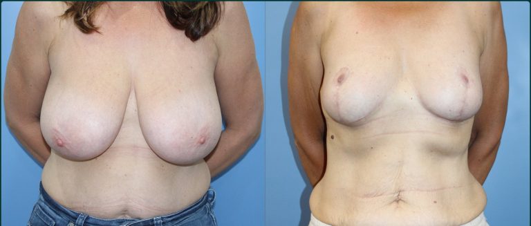 Breast reduction before and after, female patient, case BRR-L04, Dr Rohit Kumar, Sydney