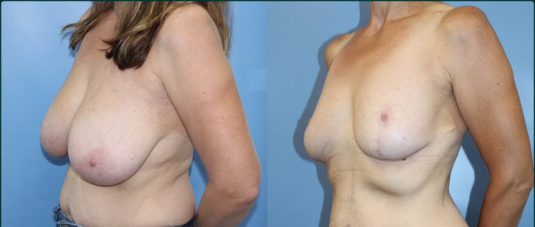 Breast reduction before and after, female patient, case BRR-L04, Dr Rohit Kumar, Sydney