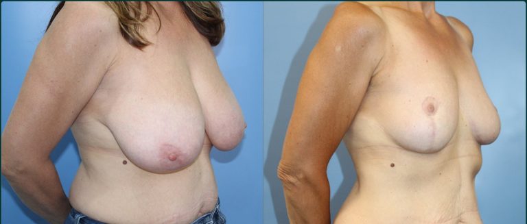 Breast reduction before and after, female patient, case BRR-L04, Dr Rohit Kumar, Sydney