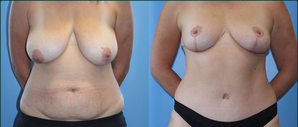 Breast reduction before and after, female patient, case BRR-L05, Dr Rohit Kumar, Sydney