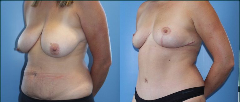 Breast reduction before and after, female patient, case BRR-L05, Dr Rohit Kumar, Sydney