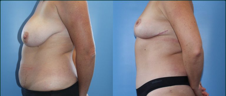 Breast reduction before and after, female patient, case BRR-L05, Dr Rohit Kumar, Sydney