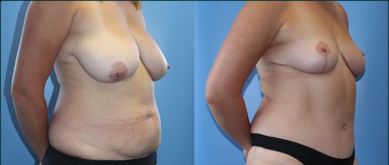 Breast reduction before and after, female patient, case BRR-L05, Dr Rohit Kumar, Sydney