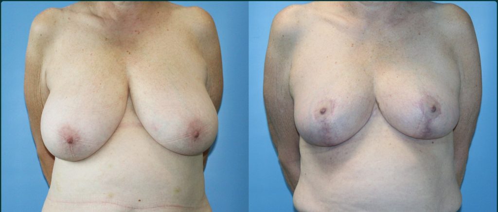 Breast reduction before and after, female patient, case BRR-L06, Dr Rohit Kumar, Sydney