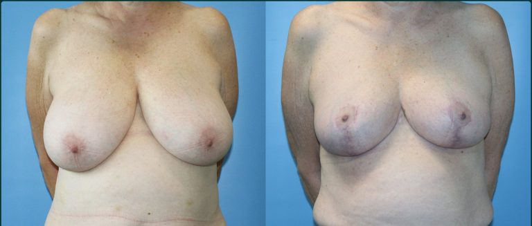 Breast reduction before and after, female patient, case BRR-L06, Dr Rohit Kumar, Sydney