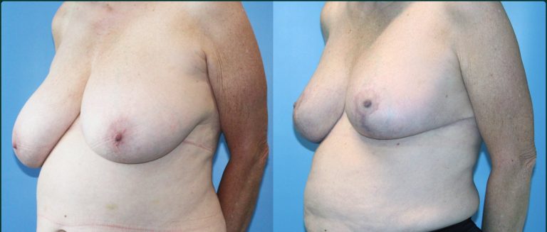 Breast reduction before and after, female patient, case BRR-L06, Dr Rohit Kumar, Sydney