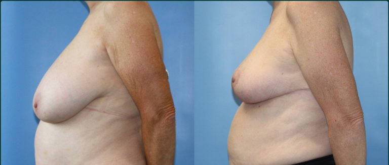 Breast reduction before and after, female patient, case BRR-L06, Dr Rohit Kumar, Sydney