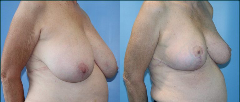 Breast reduction before and after, female patient, case BRR-L06, Dr Rohit Kumar, Sydney