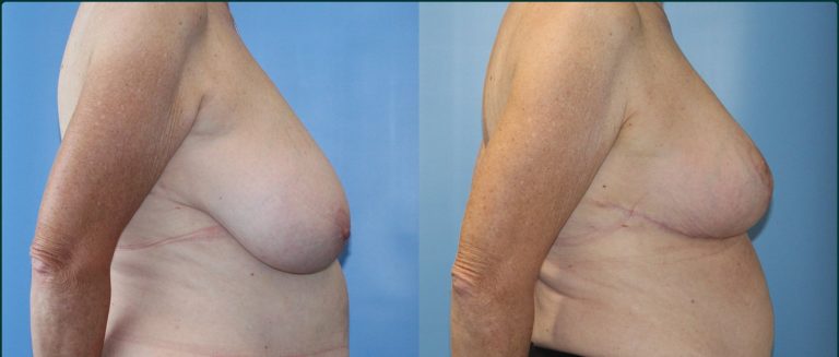 Breast reduction before and after, female patient, case BRR-L06, Dr Rohit Kumar, Sydney