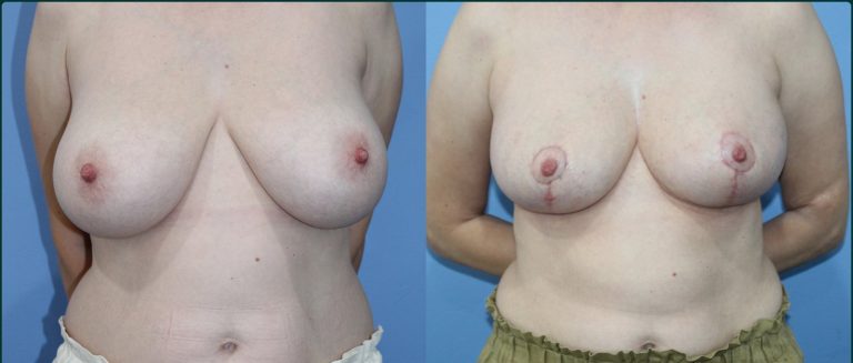 Breast reduction before and after, female patient, case BRR-L07, Dr Rohit Kumar, Sydney
